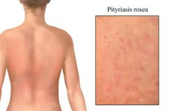 Pityriasis Rosea (Gül Hastalığı)